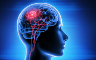 Le cancer serait lié à notre capacité à gérer notre stress